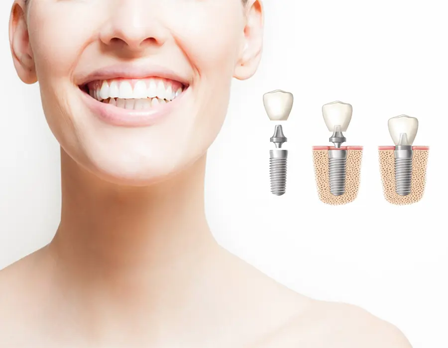 Implantes dentales para turistas